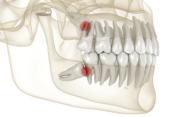 口腔外科医が埋まっている親知らずの抜歯も対応