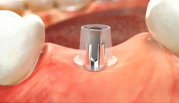 二次手術、型採り