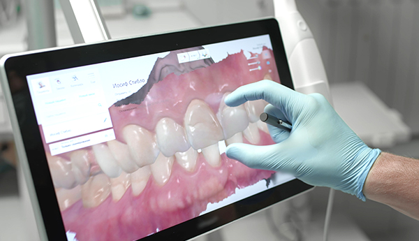 二次手術、型採り