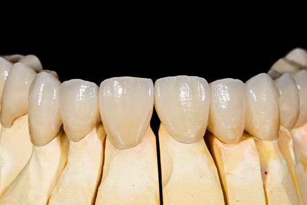 銀歯を使わないメタルフリーの治療を重視しています