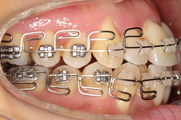 マルチループワイヤーで矯正治療を行います