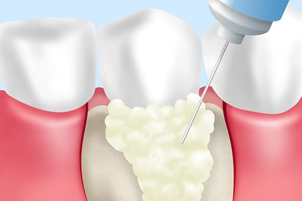 歯周組織再生療法