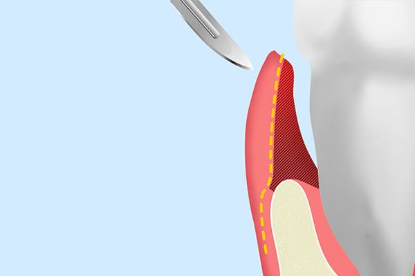 歯肉弁根尖側移動術