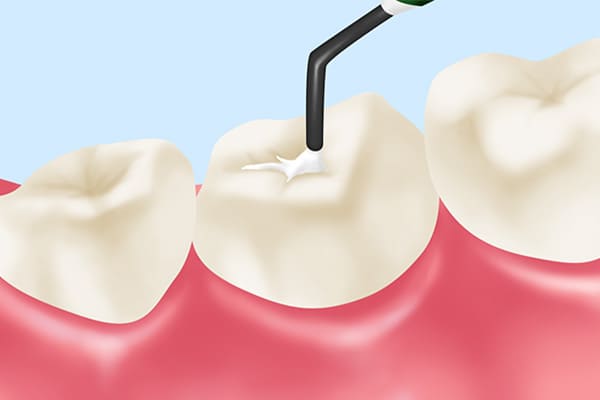 シーラントでお子さまの虫歯予防を