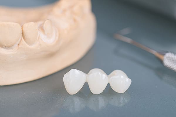 歯科先進国ではメタルフリー治療が当たり前？