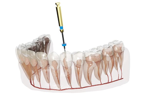 重度の虫歯でも天然歯を残せる根管治療とは